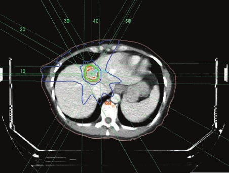ابلاغ شناسنامه و استاندارد خدمت رادیوتراپی به روش SBRT/SRS